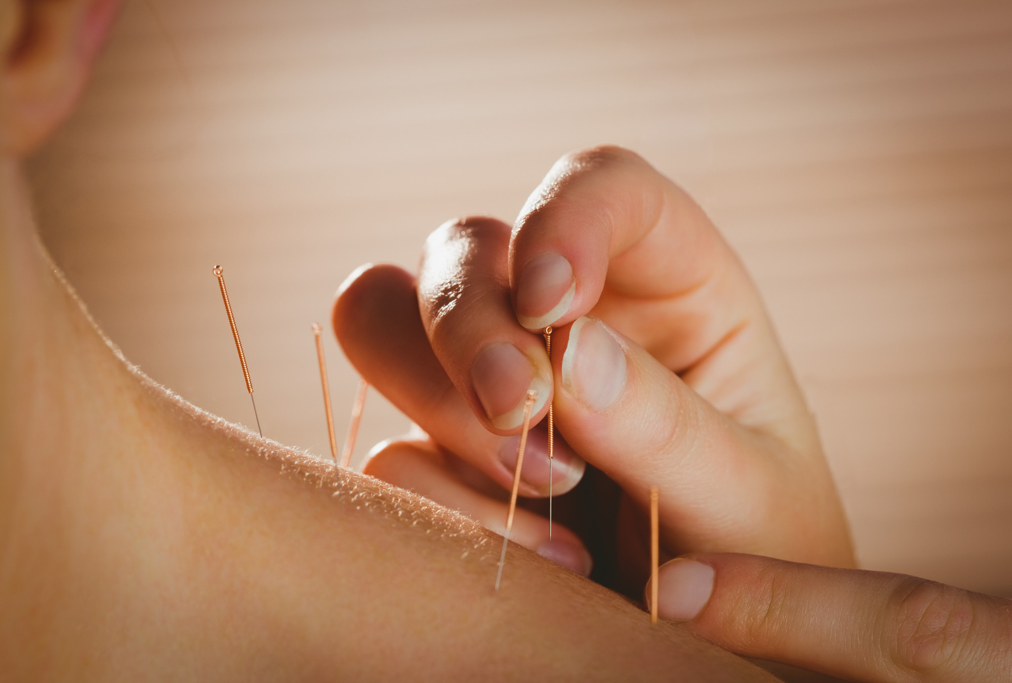 The Benefits of Acupuncture for Anxiety